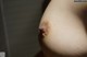 A close up of a woman's breast with a bruise on it.